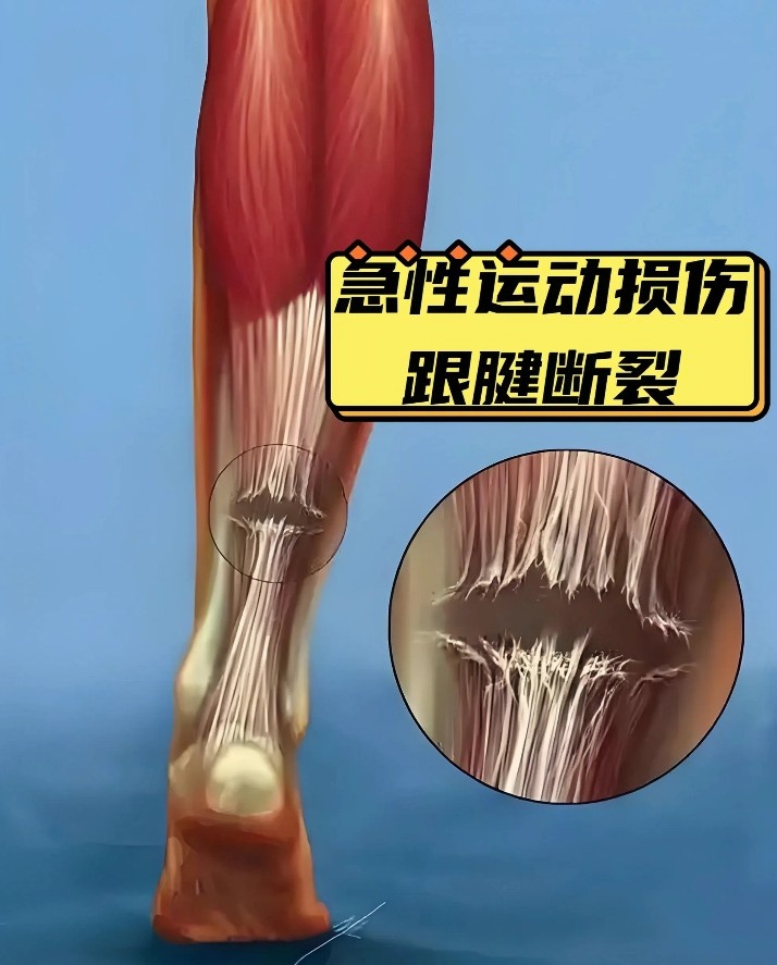10个月康复已算快!跟腱撕裂为什么是竞技体育的“阿喀琉斯之踵”